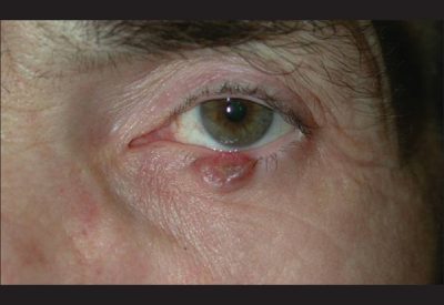 Pathology of eyelid tumors