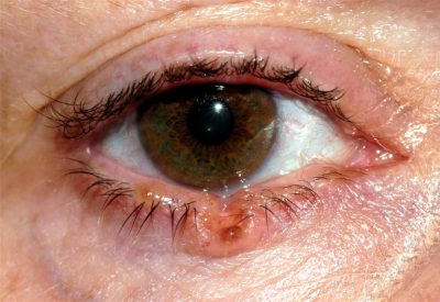 Source: https://www.google.com/search?tbm=isch&q=basal+cell+carcinoma+on+eye+lids&imgrc=RMVwQU3JCr5y8M%3A&cad=h